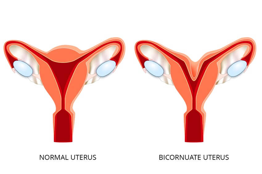 Infographic of the bicornuate uterus