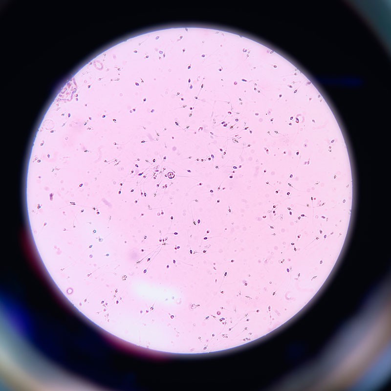 Esperma de análisis de infertilidad masculina visto al microscopio