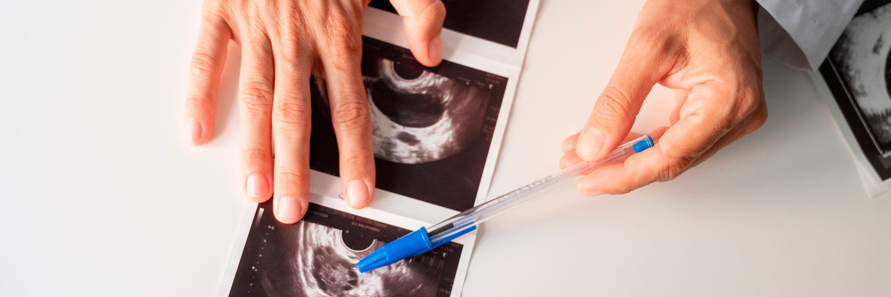 Doctor mostrando el síndrome de ovarios poliquísticos en ecografía